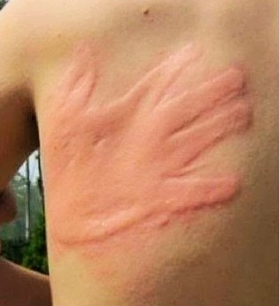 Hand prints on back by slaps 